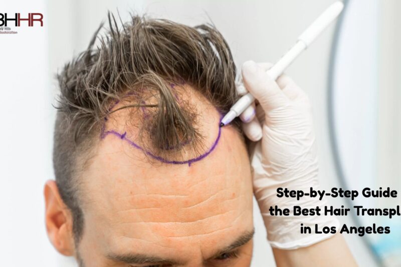 Step-by-Step Guide to the Best Hair Transplant in Los Angeles